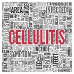 Cellulitis Treatment with 10 Natural Ingredients