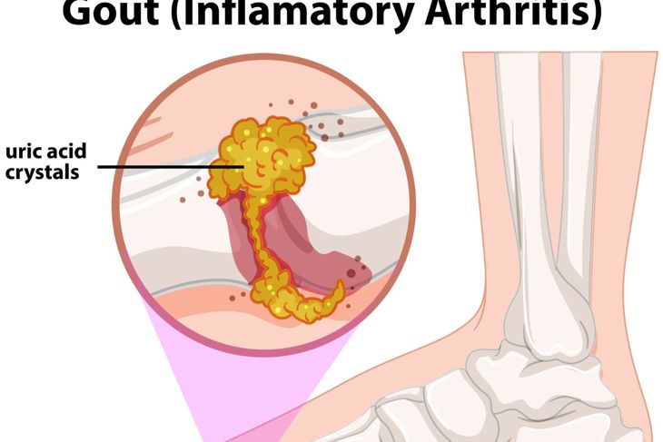 10 Remedies For Gout Facty Health