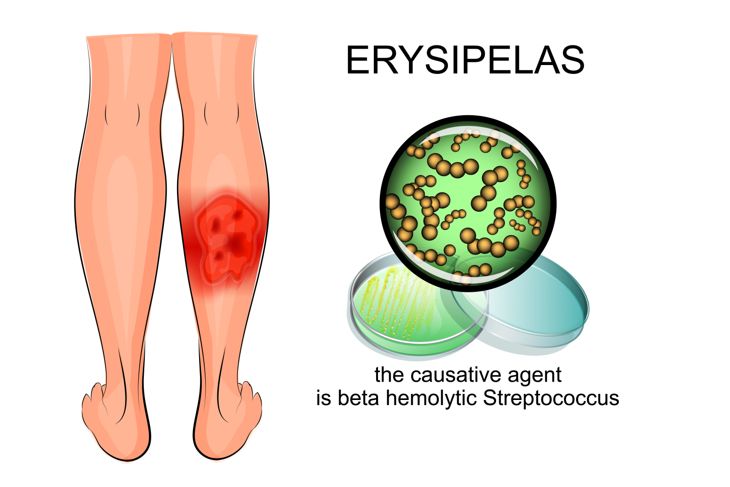 illustration of erysipelas and bacterial inoculation of the pathogen - hemolytic Streptococcus