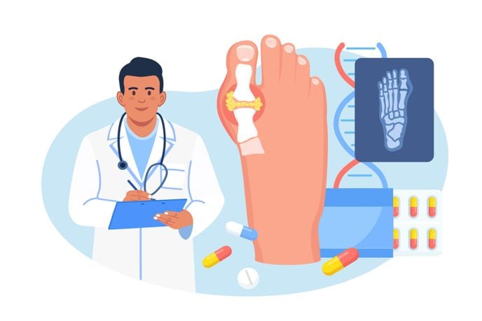 What Foods Can Cause a Gout Flare-Up?