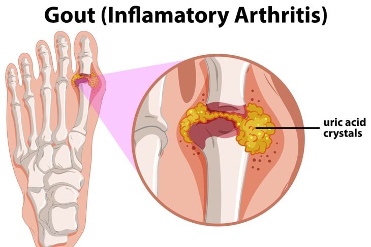 Diagram showing gout in human foot illustration