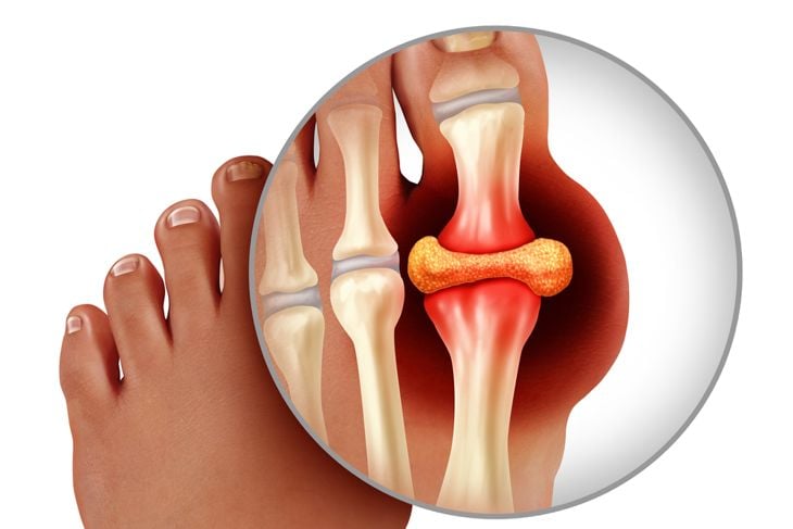 Gout pain can vary widely. Some people experience brief twinges in the early stages, while others have full-blown flare-ups that develop over several hours. These episodes may last for days or even weeks, with periods of remission in between. Without treatment, the pain often becomes more frequent and severe over time.

