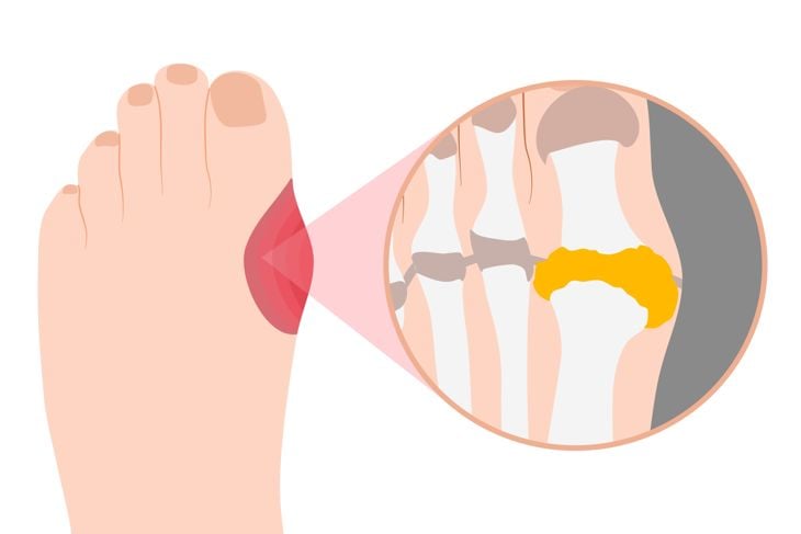 Gout is a type of inflammatory arthritis that causes pain and swelling in your joints, usually as flares that last for a week or two, and then resolve. Gout flares often begin in your big toe or a low