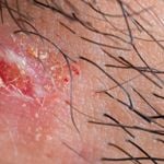 10 Ways to Heal a Blister