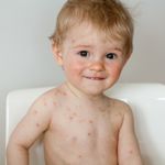 Understanding Chickenpox: Causes, Symptoms, and Prevention