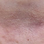 10 Types of Skin Bumps