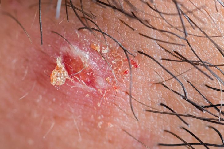 10 Ways to Heal a Blister