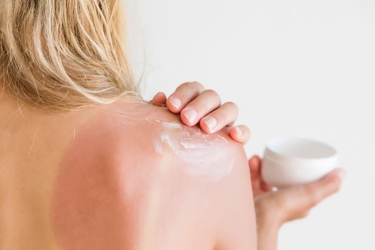 10 Sunburn Home Remedies