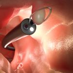9 Common Polyp Types