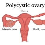 10 Fast Facts about Polycystic Ovarian Syndrome
