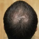 Top 9 Causes of Hair Loss in Men