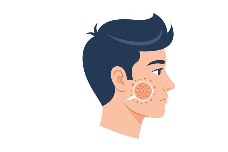 10 Acne Trigger Foods: Avoid These Foods to Prevent Breakouts!