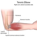 9 Treatments for Tennis Elbow