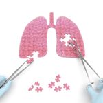Pleurisy: Recognize the Ten Warning Signs Now