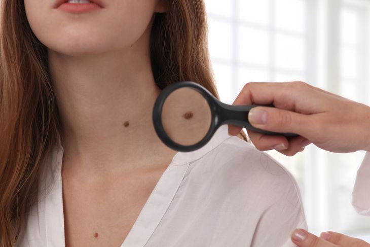 10 Home Remedies to Get Rid of Moles