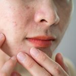 11 Pimple Remedies: Simple Solutions for Clear Skin