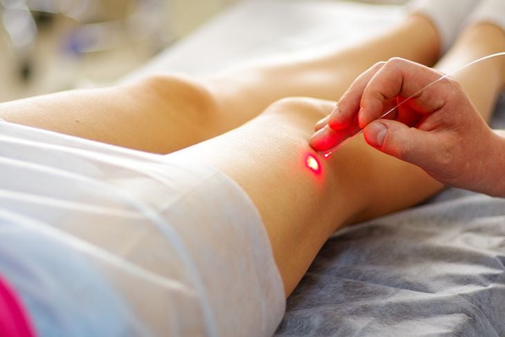 10 Ways to Get Rid of Varicose Veins