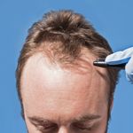 10 Things You Have To Know Before You Undergo A Hair Transplant