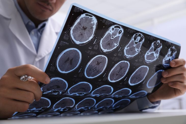 Doctor examining MRI images of patient with multiple sclerosis at table in clinic, closeup