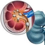 10 Remedies for Kidney Stones