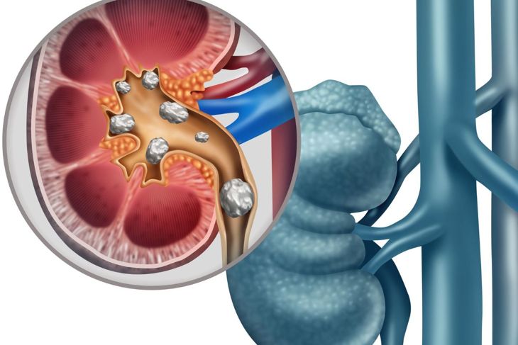 10 Remedies for Kidney Stones