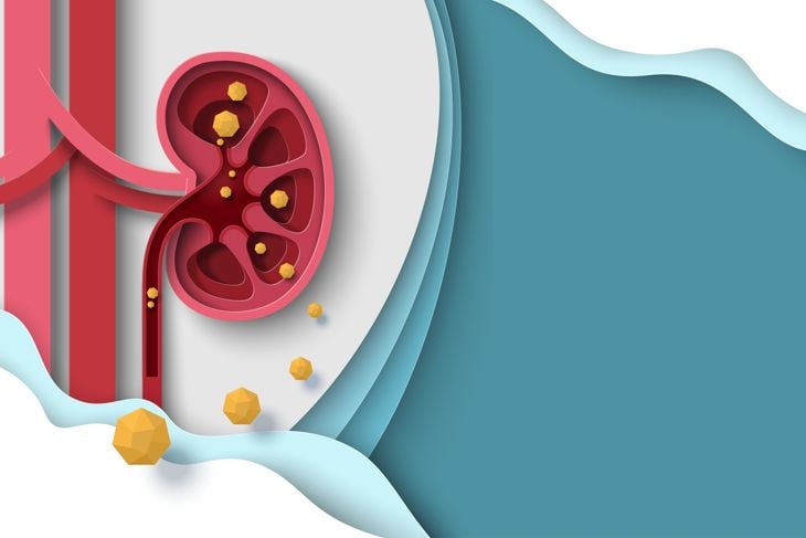 What are the 10 Indicators of Kidney Stones?
