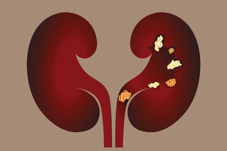 The Silent Signs: 12 Symptoms of Gout Revealed