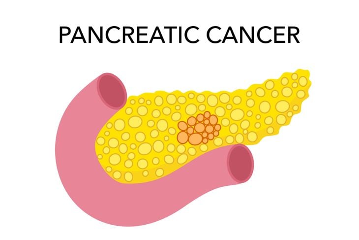 Recognizing the 25 Indicators of Pancreatic Cancer