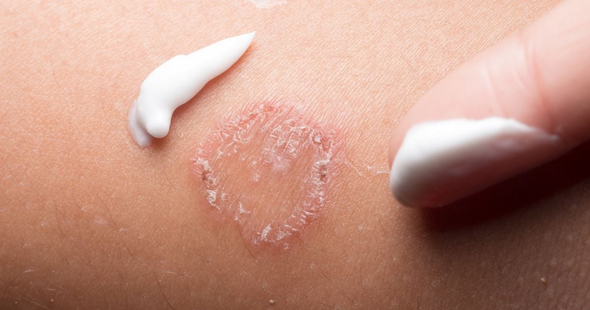 10 Symptoms of Ringworm Facty Health