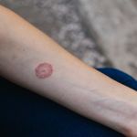 Recognizing Ringworm: 10 Key Symptoms