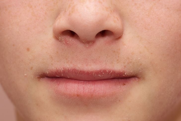 10 Remedies for Dry Mouth