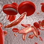 10 Symptoms of Sickle Cell Anemia