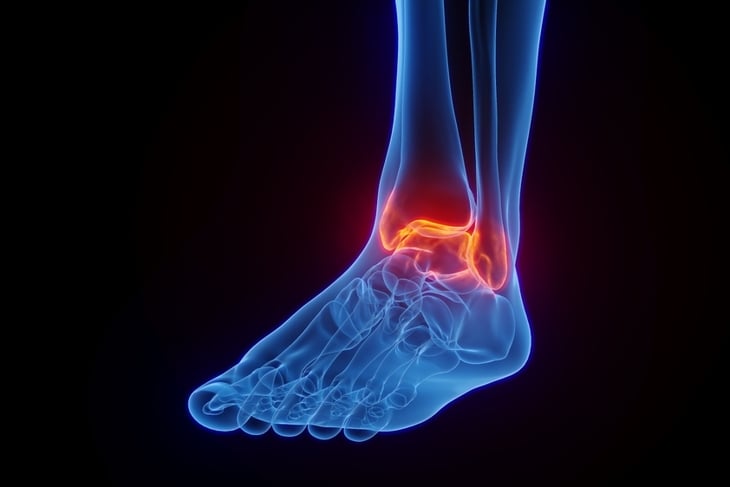 Medical Illustration of Inflamed Ankle