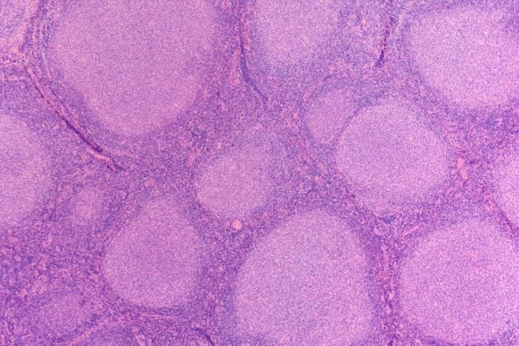 Early Detection: 10 Warning Signs of Non-Hodgkin Lymphoma