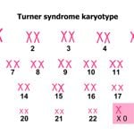 10 Symptoms of Turner Syndrome
