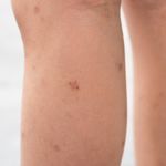 10 Key Indicators of Kaposi Sarcoma