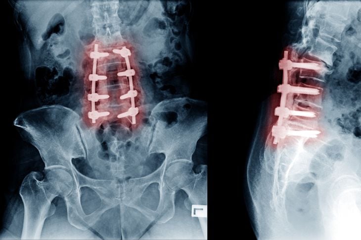 Understanding Degenerative Disc Disease: Common Symptoms
