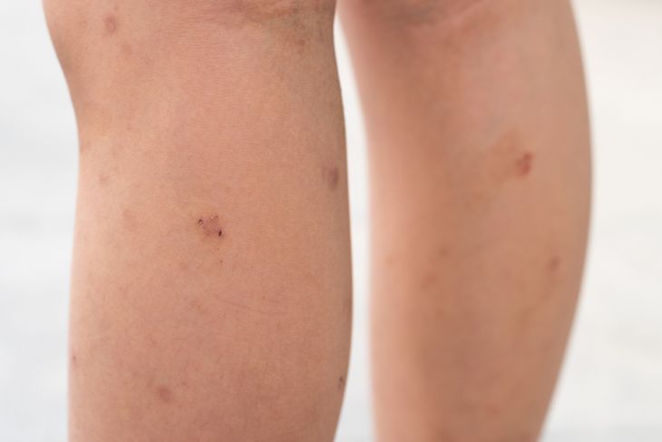 10 Key Indicators of Kaposi Sarcoma