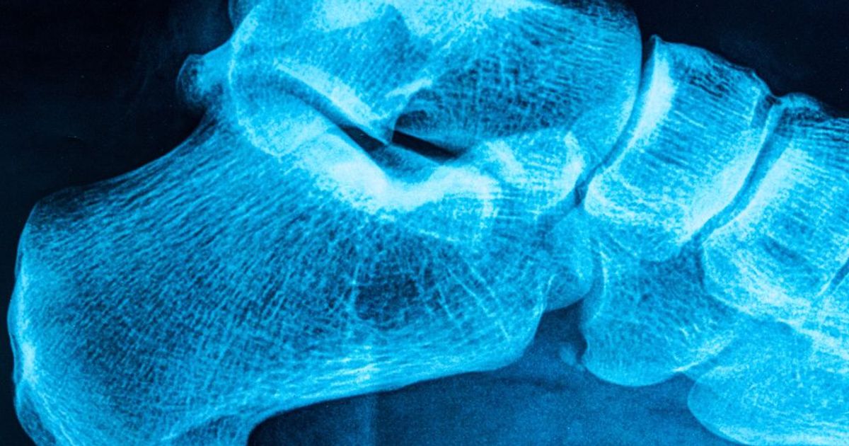 10 Home Remedies for Heel Spurs Facty Health