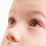 DIY Pink Eye Treatments at Home