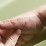 Easy and Natural Ways to Treat Fever Blisters at Home