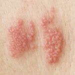 10 Home Remedies for Shingles