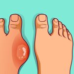 24 Home Remedies for Gout