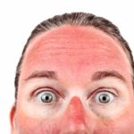 10 Home Remedies for Sunburn