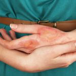 10 Home Remedies for Burns