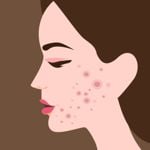 Discover 10 Effective Home Remedies for Acne