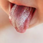 Discover the Power of 10 Home Remedies for Thrush