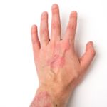 10 Home Remedies for Psoriasis