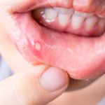 Effective Home Remedies: 10 Ways to Treat Canker Sores