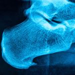10 Home Remedies for Heel Spurs
